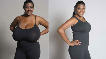 reduction seins