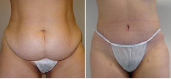 resultat abdominoplastie