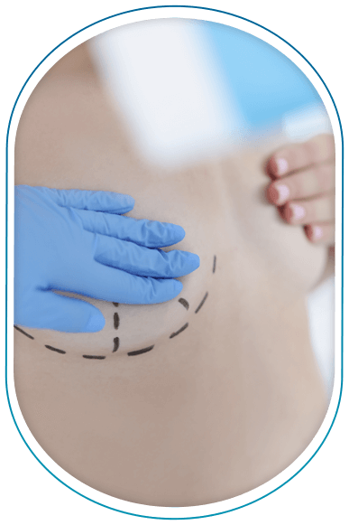 Suites opératoires d’une chirurgie d’augmentation mammaire par injection en Tunisie