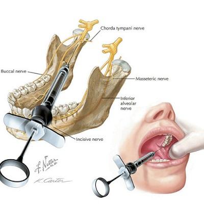 douleur implant dentaire