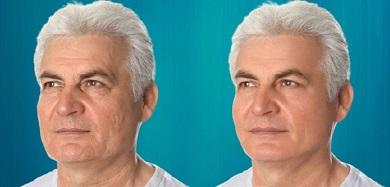 blépharoplastie du regard